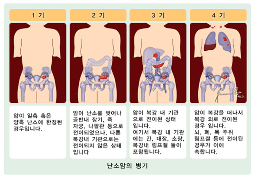 난소암의 병기안내. 1기- 암이 일측 혹은 양측 난소에 한정된 경우입니다. 2기- 암이 난소를 벗어나 골반내 장기, 즉 자궁, 나팔관 등으로 전이되었으나, 다른 복강내 기관으로는 전이되지 않은 상태 입니다. 3기- 암이 복강 내 기관 으로 전이된 상태 입니다. 여기서 복강 내 기관 에는 간, 대장, 소장, 복강내 림프절 들이 포함됩니다. 4기- 암이 복강을 떠나서 복강 외로 전이된 경우 입니다. 뇌, 폐, 목 주위 림프절 등에 전이된 경우가 이에 속합니다.