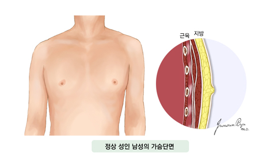 남성유방암  발생부위 : 정상 성인 남성의 가슴단면, 근육, 지방