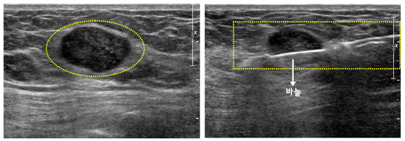 총생검 초음파 사진과 총생검 시술 사진
