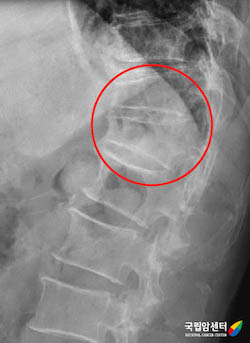다발골수종 환자에서 발생한 척추뼈의 압박 골절(X ray)