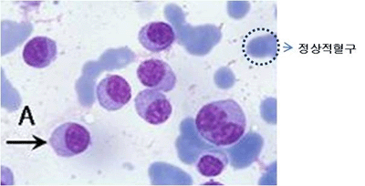 다발골수종의 골수검사소견 - 정상적혈구