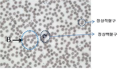 다발골수종의 말초혈액 도말검사소견 - 정상적혈구, 정상백혈구
