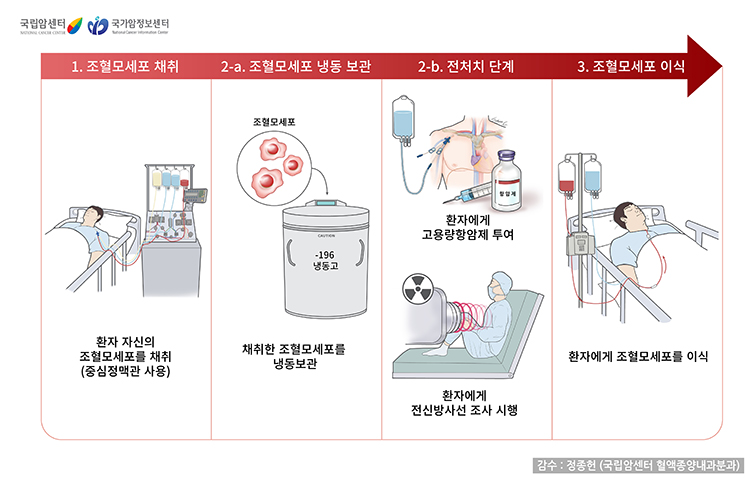 자가조혈모세포이식 과정