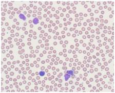 만성림프구백혈병으로 진단된 환자의 말초혈액도말소견