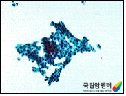 요세포검사에서 악성 세포 소견