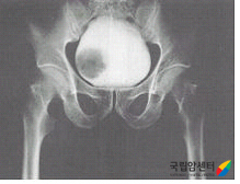 방광암의 배설요로조영술 소견