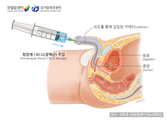 방광암-방광내약물주입법