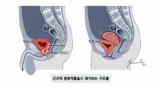 근치적 방광적출술시 제거되는 구조물 - 남 : 방광, 정낭, 전립선,  여 : 자궁, 방광