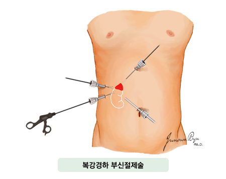 복강경하 부신절제술
