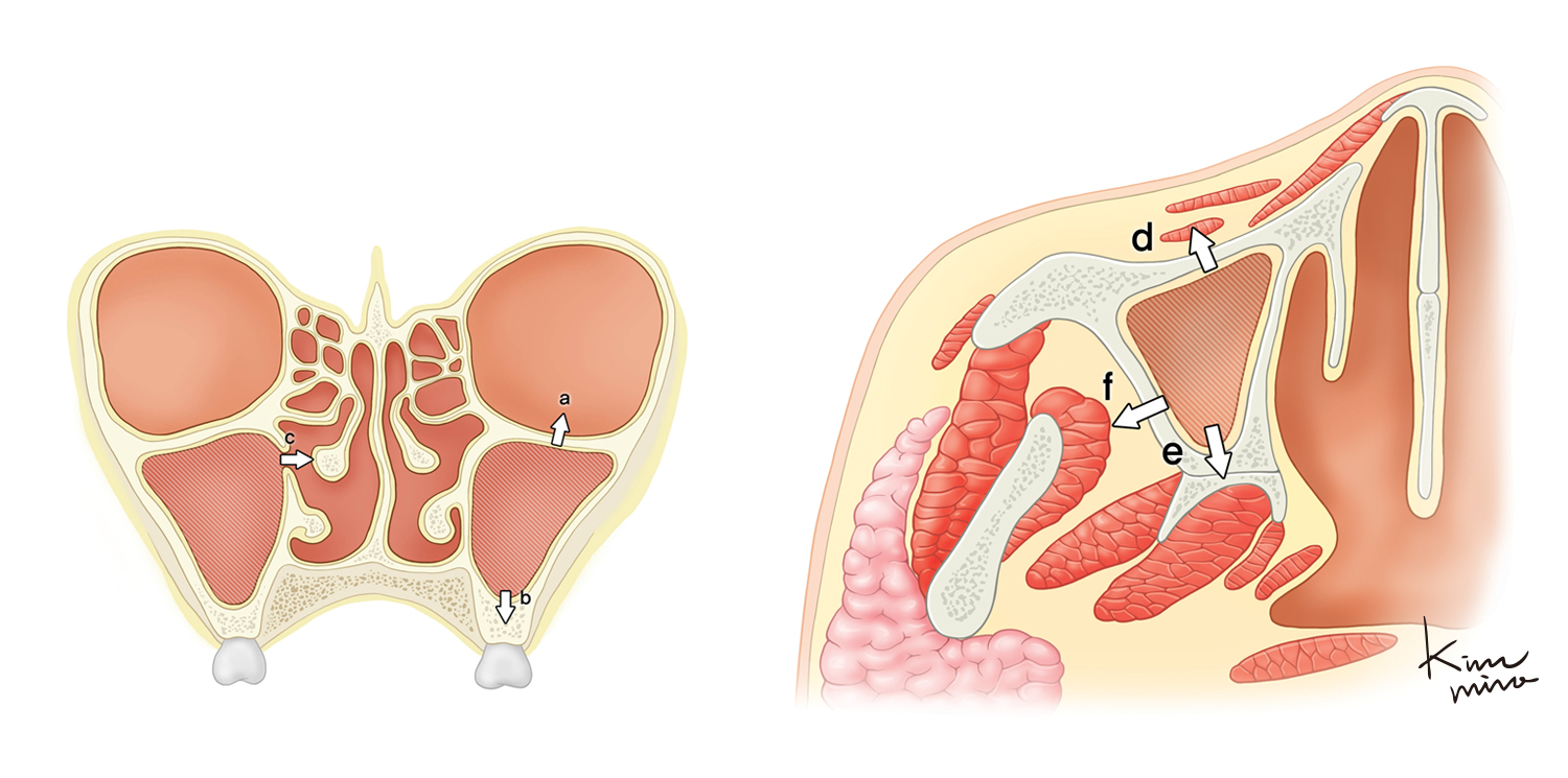 비부비동암 진행단계