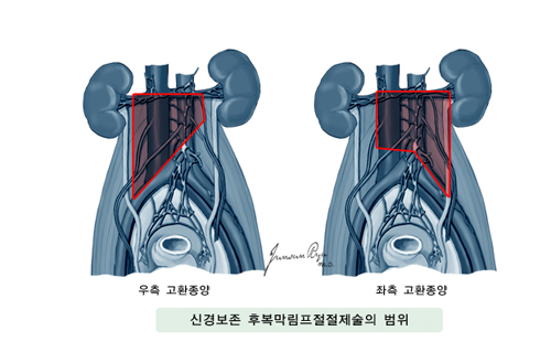 신경보존 후복막림프절 절제술의 범위 - 우측 고환종양, 좌측 고환종양