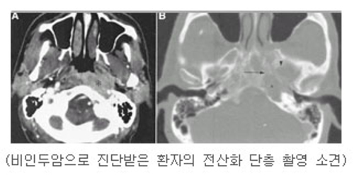 비인두암으로 진단받은 환자의 전산화 단층 촬영 소견