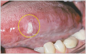 혀에 발생한 백반증
