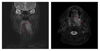 좌측 설암의 자기공명영상 촬영 이미지