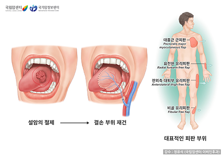 설암의 수술과 대표적인 피판 부위