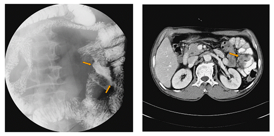 소장(공장)암의 소장조영검사 소견 및 전산화단층촬영 소견