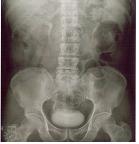 경정맥신우조영술