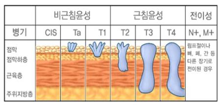 신우암의 진행단계 - 병기, 점막, 점막하층, 근육층, 주위지방층, 비근침윤성(CIS, Ta, T1), 근침윤성(T2, T3, T4), 전이성 (N+, M+) : 림프절이나 뼈, 폐, 간 등 다른 장기로 전이된 경우