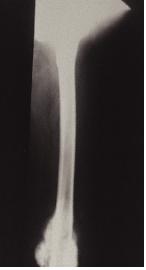 악성 골종양의 단순 방사선 사진