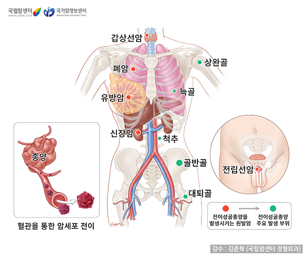 전이성 골종양