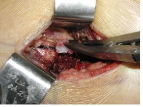 절개 생검 수술 사진