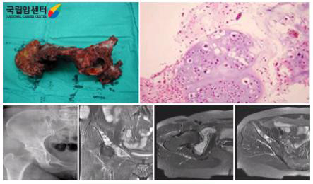 오른쪽 골반골의 연골육종