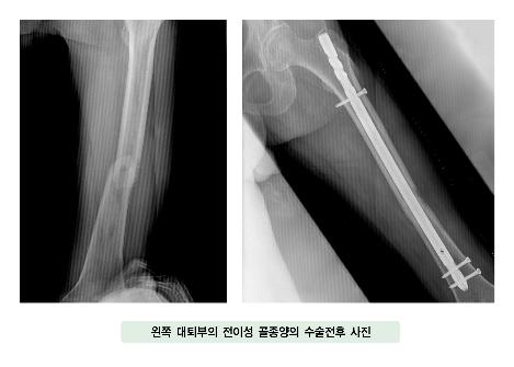 왼쪽 대퇴부의 전이성 골종양의 수술전후 사진