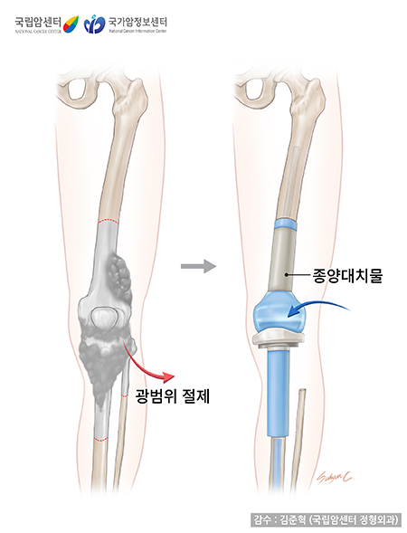 종양 대치물 삽입술