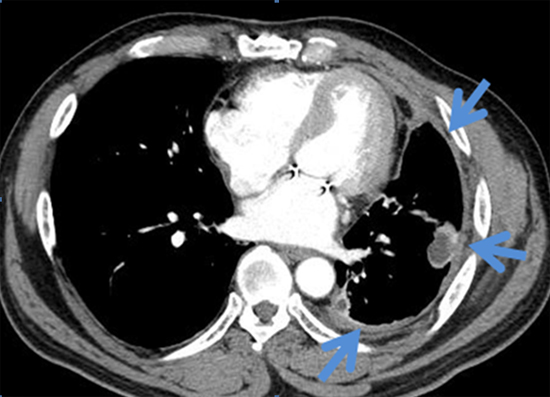 악성중피종의 전산화단층촬영 소견