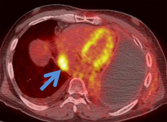 악성중피종의 양전자방출단층촬영-전산화단층촬영 복합영상