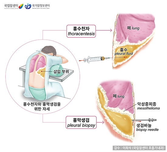 흉수 천자와 흉막 생검