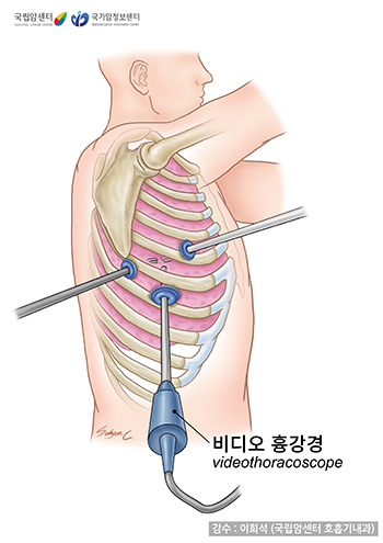 비디오 흉강경검사(VATS)