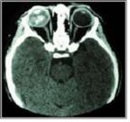 안종양 방사선 사진