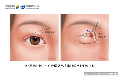 안와 종양 제거술