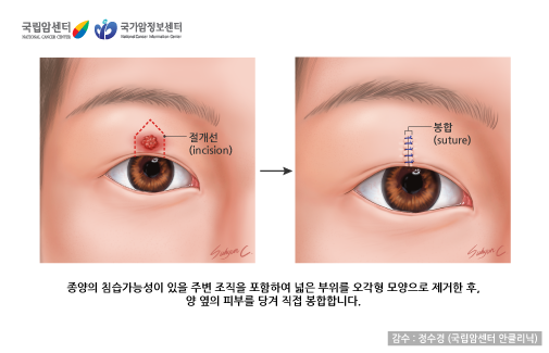 눈꺼풀 종양 제거술