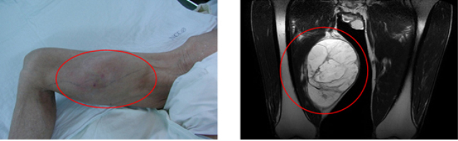 오른쪽 대퇴부 지방육종 환자의 사진