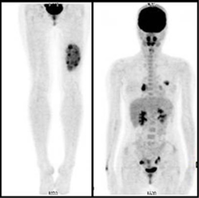 대퇴부에 발생한 포상연부육종(Alveolar soft part sarcoma) 환자의 PET소견