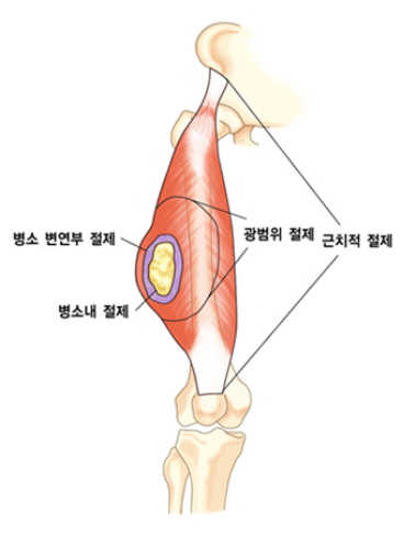 연부조직 육종의 수술 방식