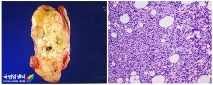 절제해낸 지방육종의 단면과 병리