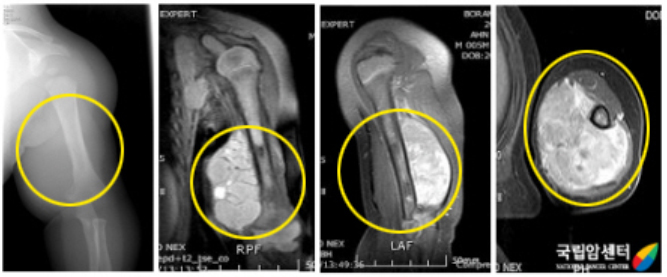 왼쪽 상완부에 횡문근육종을 가진 환아의 사진