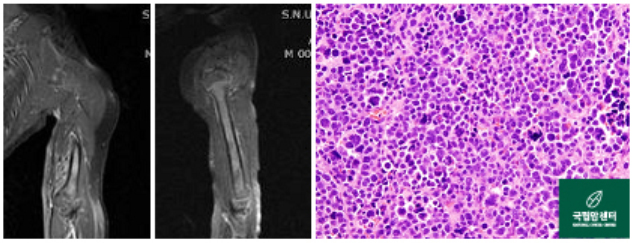 위 환아의 항암약물치료 후 사진과 병리 사진
