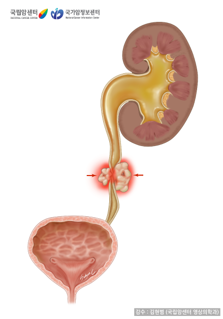 암으로 인해 수신증이 생긴 상태