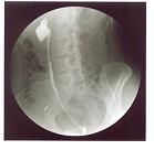 역행성신우조영술