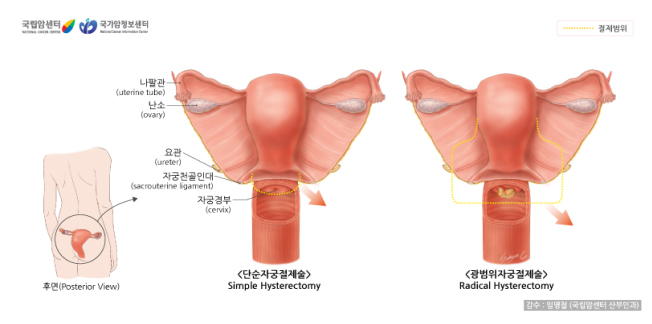 단순자궁절제술과 광범위자궁절제술