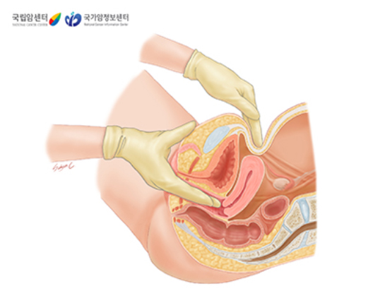 골반내진검사
