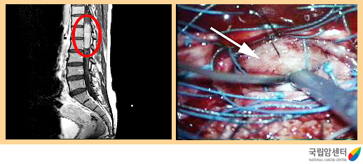척수종양의 자기공명영상촬영(MRI) 및 척수종양 수술 장면
