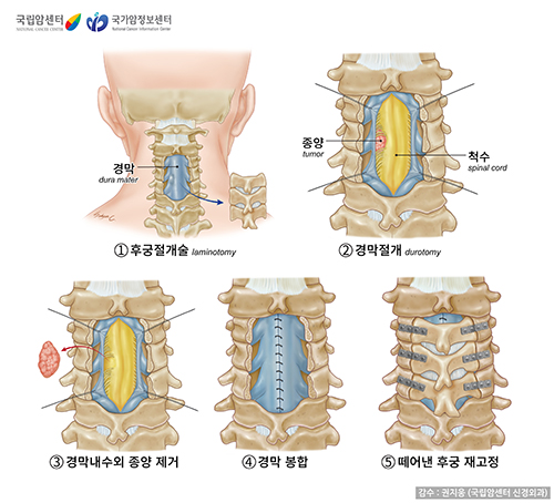 경막내수외 척수종양 제거 수술