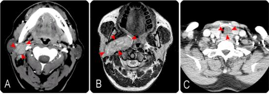 침샘종양의 영상검사소견