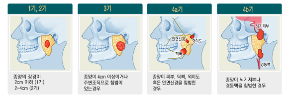 침샘암의 진행단계 - 1기, 2기 : 종양의 장경이 2cm 이하(1기)  2~4cm(2기),  3기 : 종양이 4cm 이상이거나 주변조직으로 침범이 있는 경우 4a기 : 종양이 피부, 턱뼈, 외이도 혹은 안면신경을 침범한 경우  4b기 : 종양이 죄기저부나 경동맥을 침범한 경우