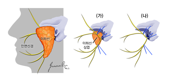 이하선종양의 수술 - 이하선, 안면신경, 이하선 심엽